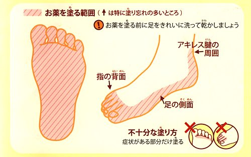 水虫 市販 薬 完治