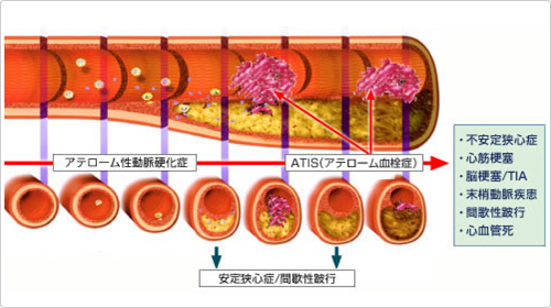 硬化 と は 動脈 動脈硬化指数の計算方法と基準値