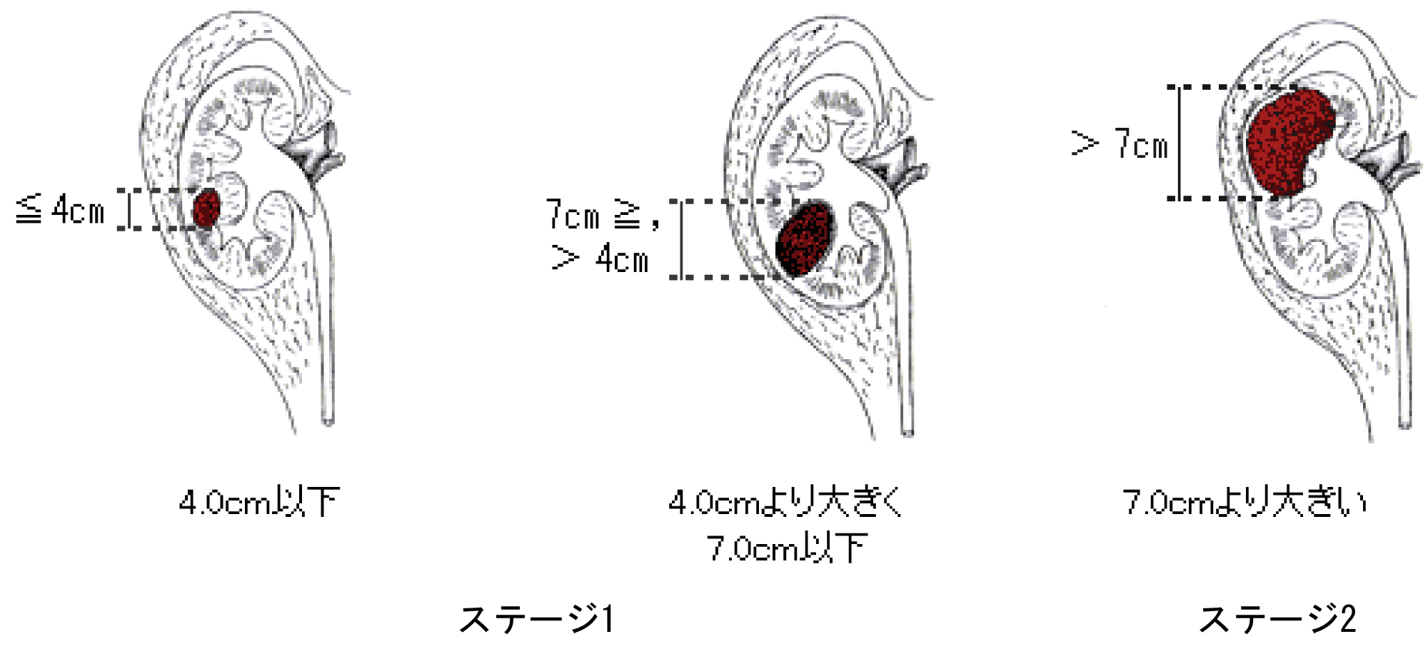 腎臓 が ん 症状