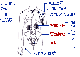 腎臓 が ん 症状