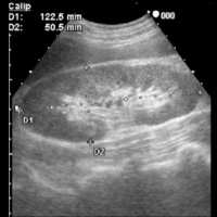 腎臓超音波（エコー）検査 