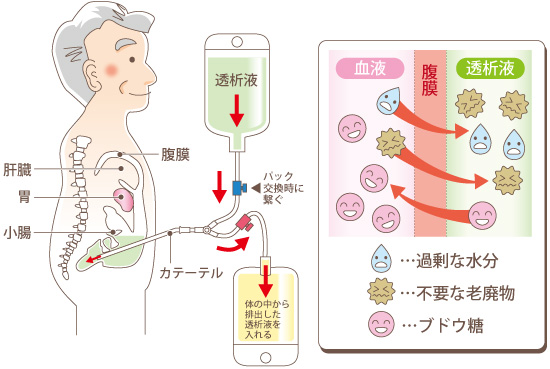 腹膜透析