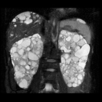 多発性嚢胞腎検査02