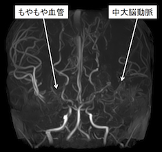 脳血管障害 もやもや病 東京女子医科大学脳神経外科