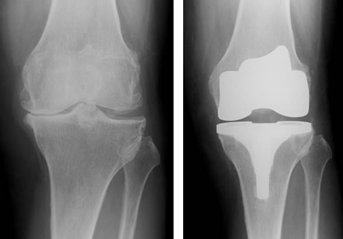 TKA(人工膝関節全置換術)
