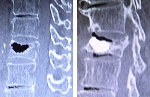 経皮的椎体形成術施行例