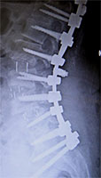脊椎固定術イメージ