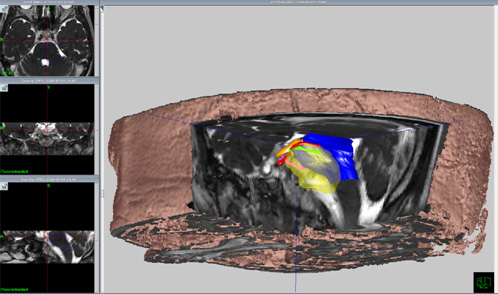 頭蓋底髄膜腫術前シミュレーション３D画像