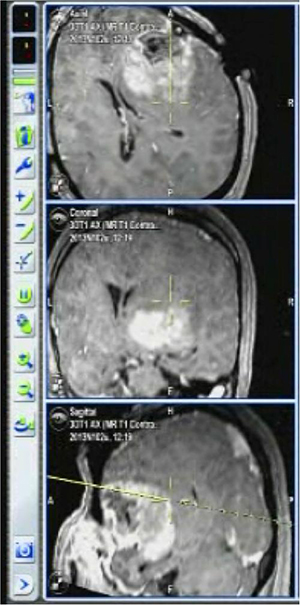 術中MRIでアップデートし誤差の少ないナビゲーションシステム