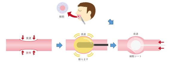 「早期食道癌ESD治療後の食道狭窄に対する細胞シート治療の臨床研究」概要図