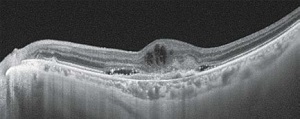 滲出型加齢黄斑変性の患部。網膜に浮腫が見られる。