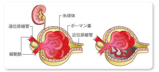 巣状分節性糸球体硬化症