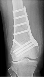 遠位大腿骨骨切り術（Distal femoral osteotomy：DFO）