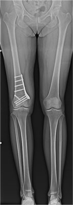遠位大腿骨骨切り術（Distal femoral osteotomy：DFO）