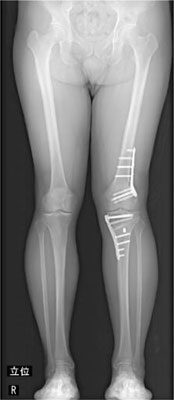 大腿骨脛骨骨切り術（Double level osteotomy：DLO）
