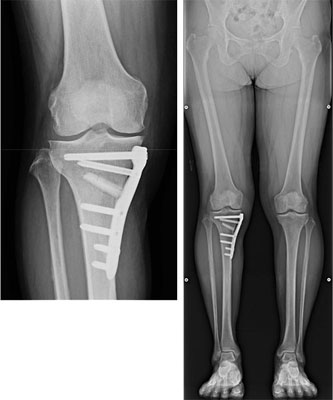 内側楔状開大型高位脛骨骨切り術（OWHTO） 術後