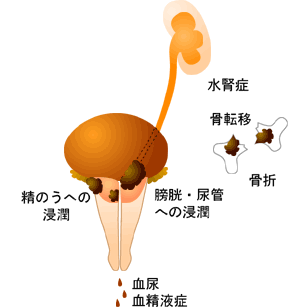 前立腺がん前立腺がんとは