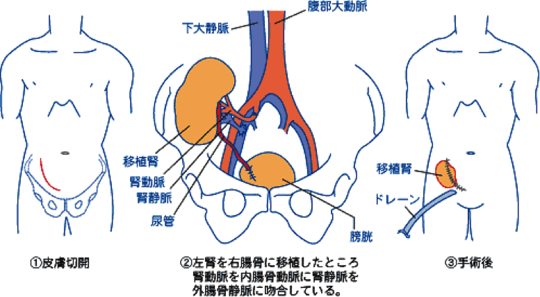 化学療法は腎不全を引き起こす可能性がありますか?