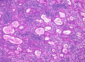 腺房細胞癌の症状は何ですか?