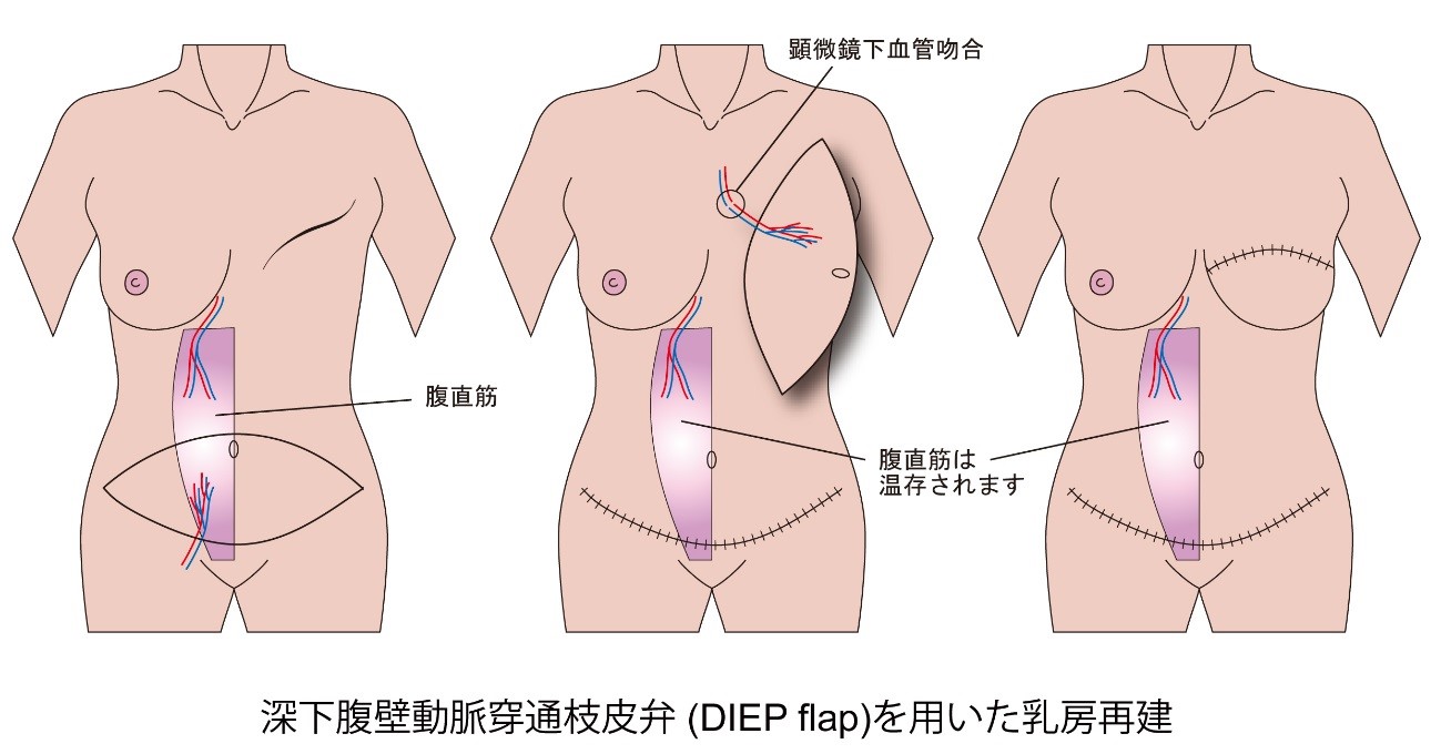 深化腹壁動脈穿通枝皮弁(DIEP flap)を用いた乳房再建