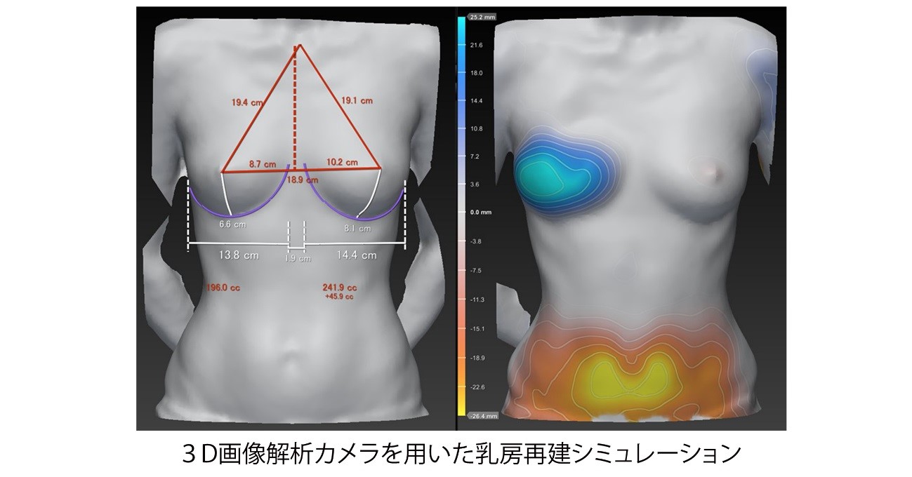 3D画像解析カメラを用いた乳房再建シミュレーション
