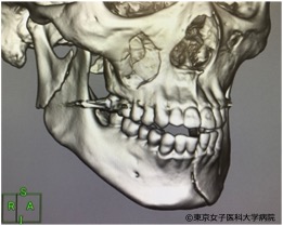 口腔機能低下症