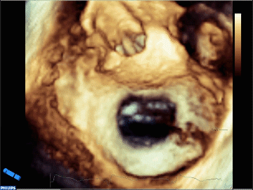 経食道心エコーによる僧帽弁3D画像