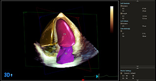 3D心臓超音波による左室駆出率計測