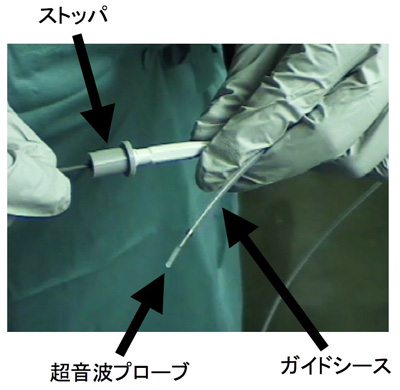 ガイドシース併用気管支腔内超音波断層法(EBUS-GS)