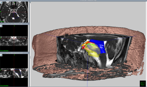 頭蓋底髄膜腫術前シミュレーション3D画像