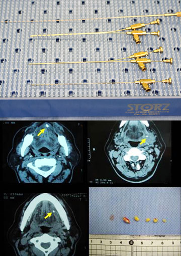 IALENDOSCOPY(唾液管内視鏡)による摘出術