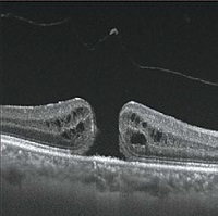 黄斑円孔の手術前
